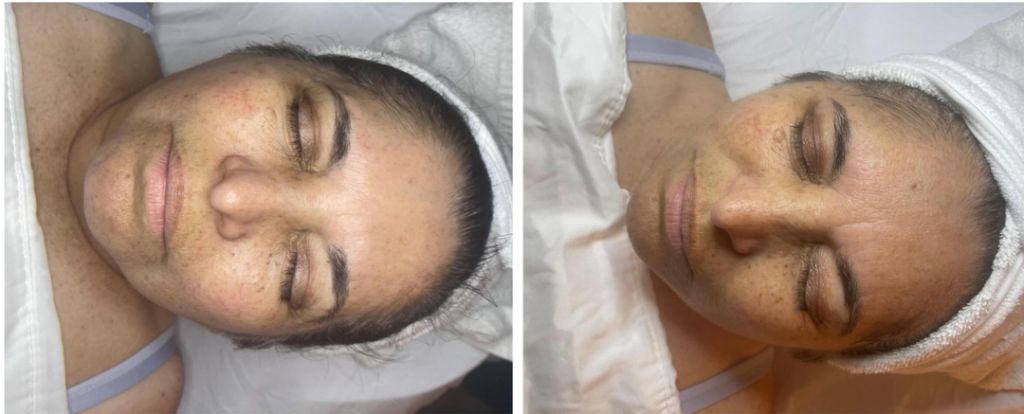 Before and After Zahav Medspa Skin Treatment