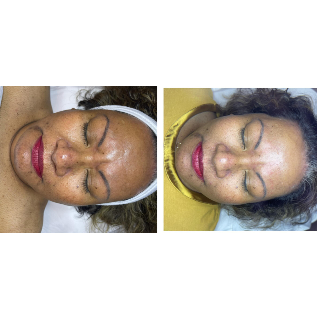 Before and After Zahav Medspa Skin Treatment