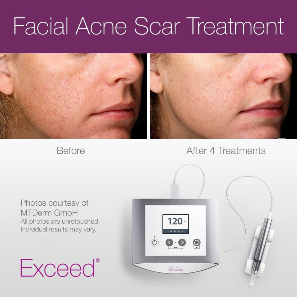 Microneedling results at Zahav Medspa, Scottsdale AZ