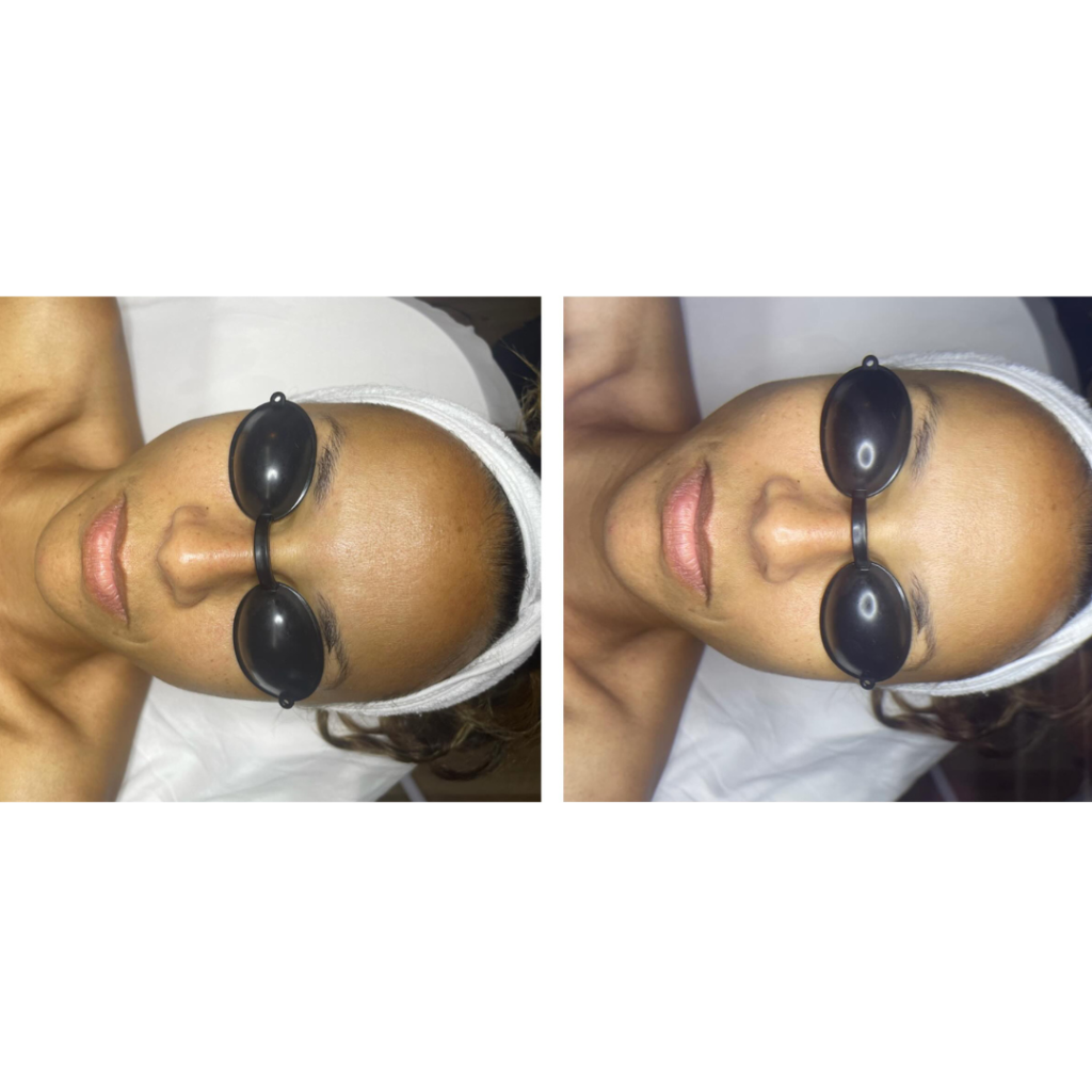 Before and After Zahav Medspa Skin Treatment