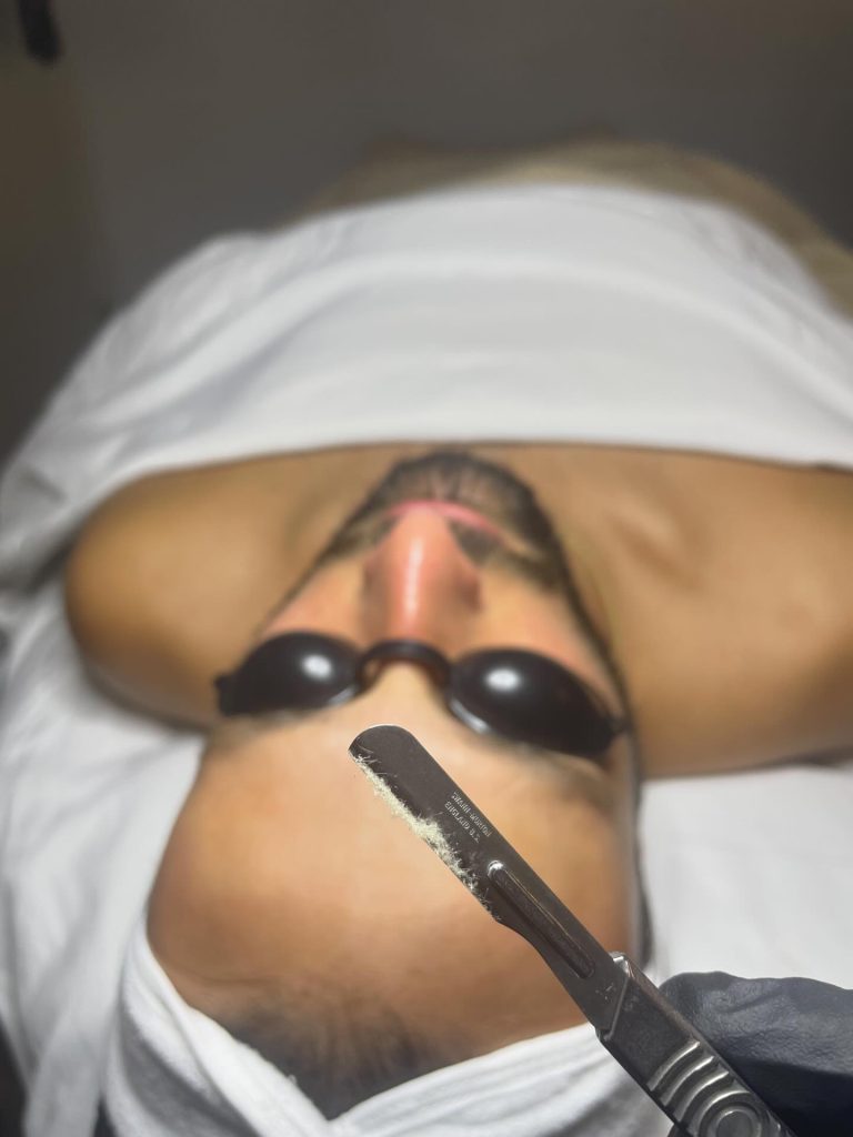 Dermaplaning results at Zahav Medspa, Scottsdale AZ