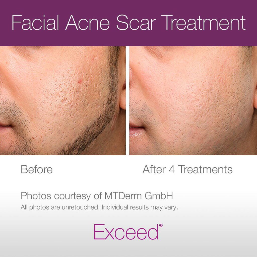Microneedling results at Zahav Medspa, Scottsdale AZ