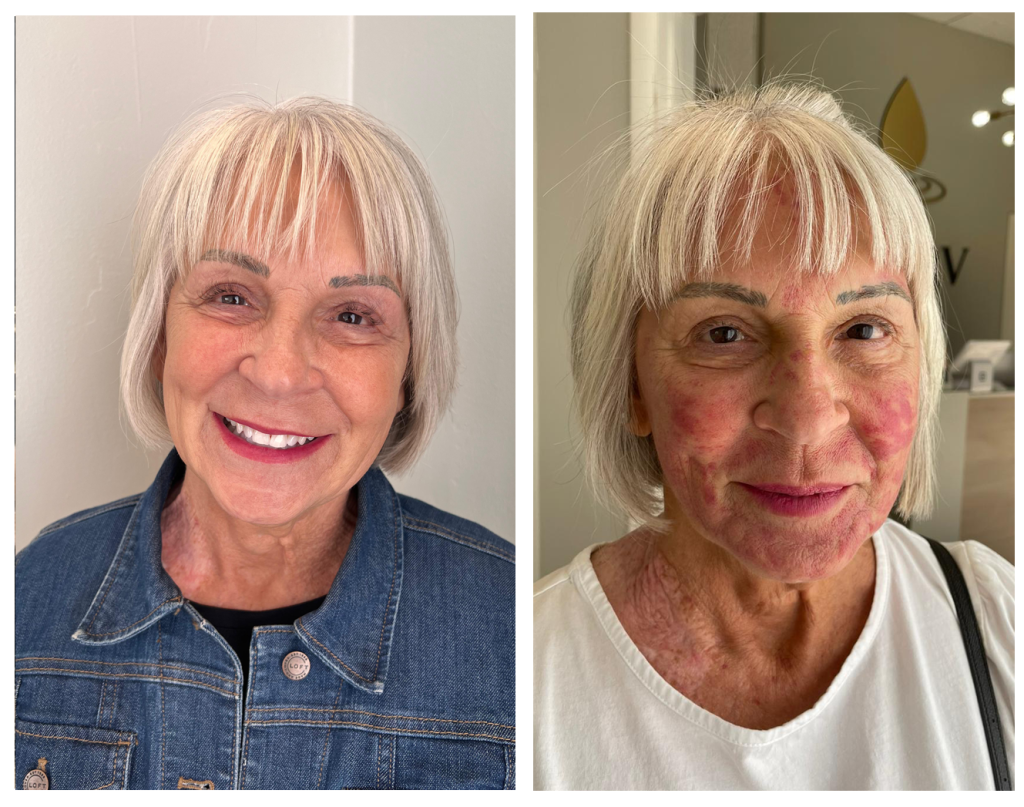 Sherry's skincare transformation before and after – Zahav Medspa, Scottsdale AZ