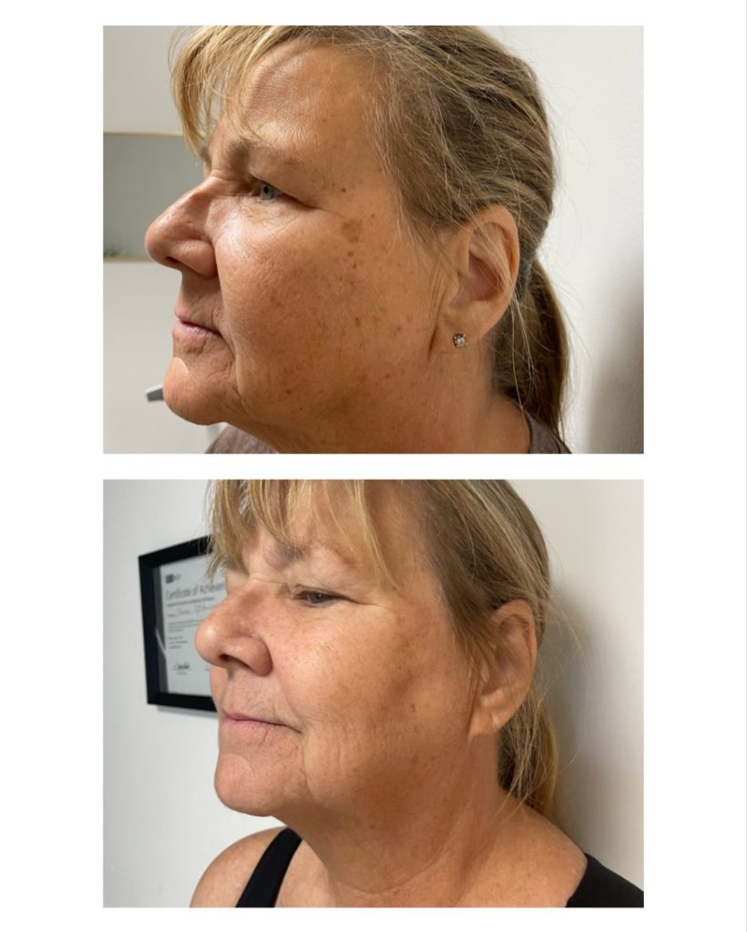 MicroPeel results at Zahav Medspa, Scottsdale AZ